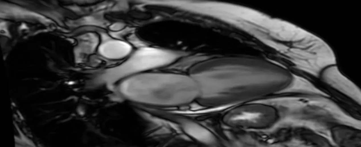 Ressonância do Coração: como funciona e por que esse exame é tão importante